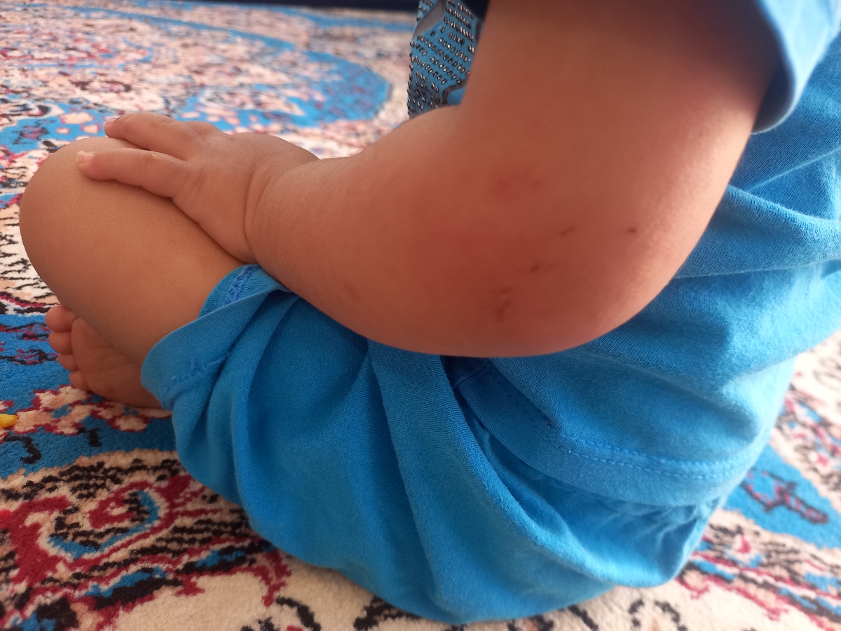 زخم یا آلرژی کودک زخم یا آلرژی کودک