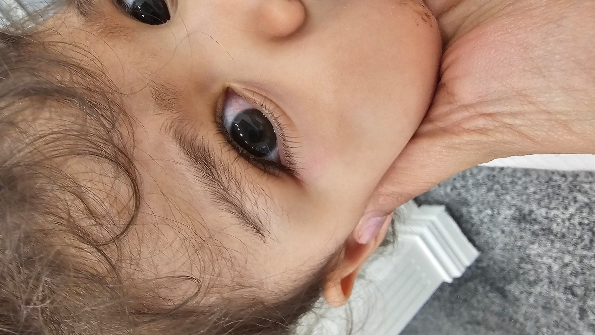 ضربه به کنار چشم کودک یکسال و ده ماهه ضربه به کنار چشم کودک یکسال و ده ماهه