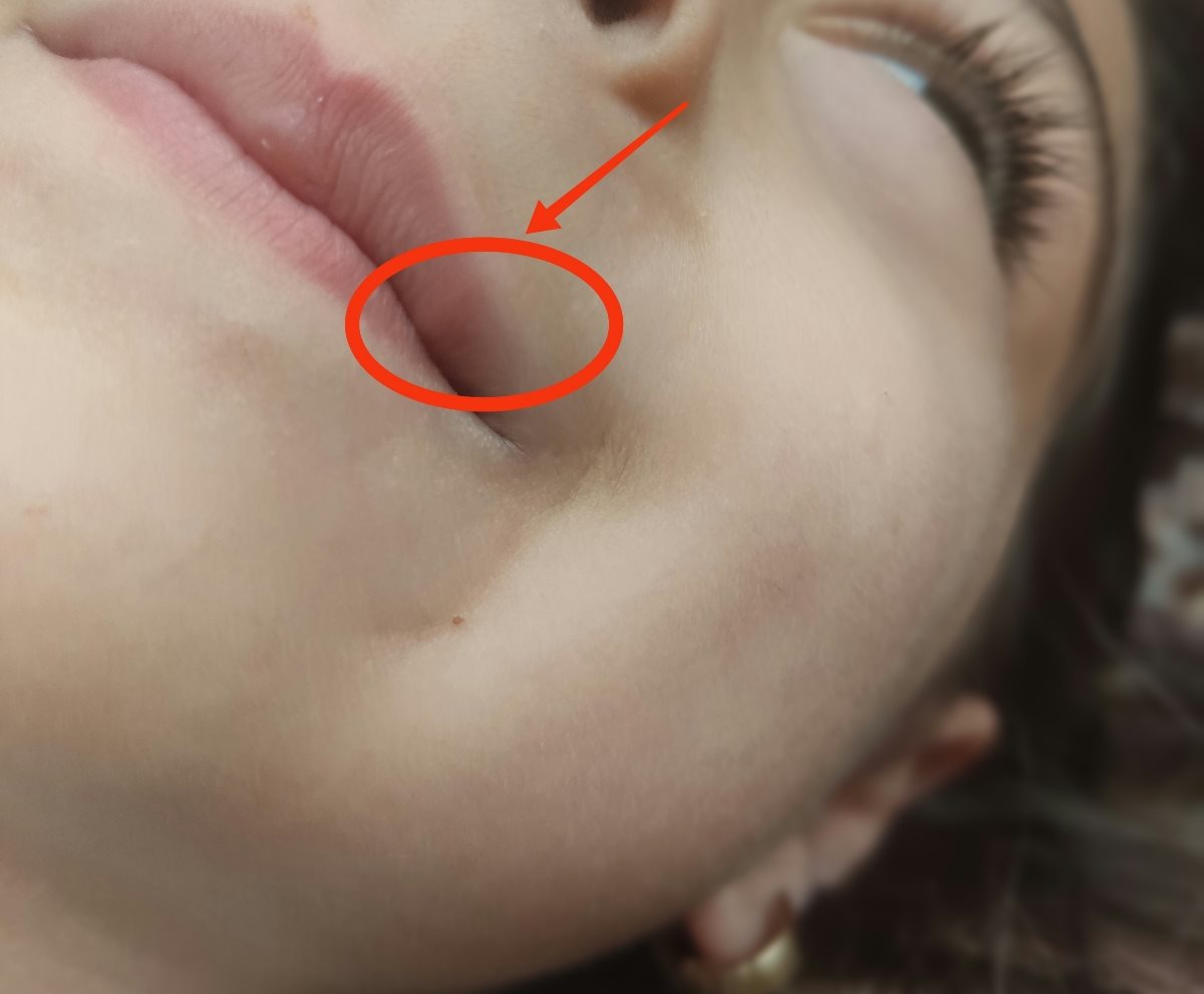 ورم لب کودک چهارساله