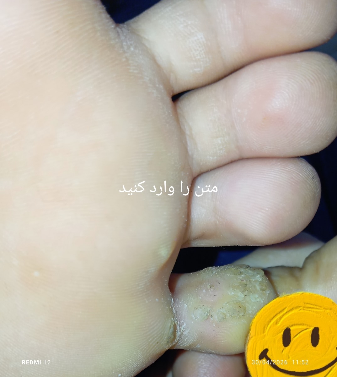 سلام خانوما بیاین ببینید این میخچس؟