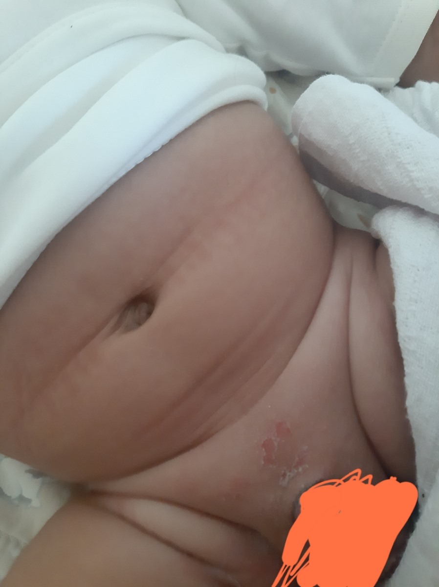 قرمز و پوسته پوسته شدن