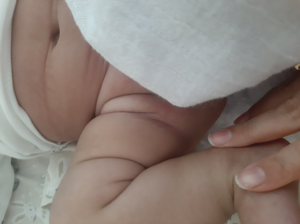 قرمز و پوسته پوسته شدن