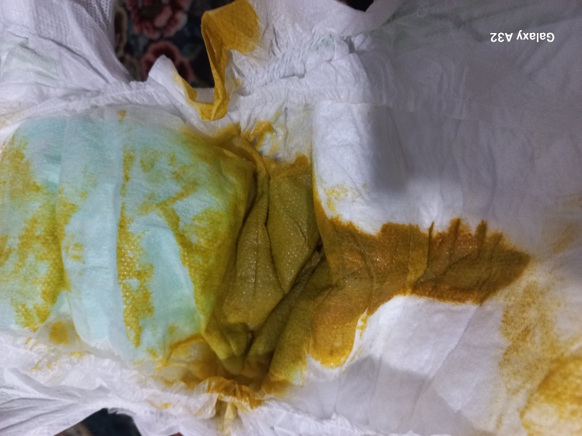 سرماخوردگی تب در نوزاد ۲ماهه سرماخوردگی تب در نوزاد ۲ماهه