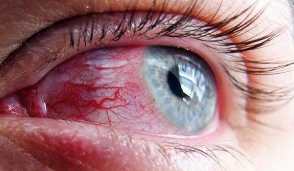 چشم من اینشکلی میشد با درددد وحشتناککک البته این قرمزی خوبه مال من چندین برابر این قرمز میشد چشم من اینشکلی میشد با درددد وحشتناککک البته این قرمزی خوبه مال من چندین برابر این قرمز میشد