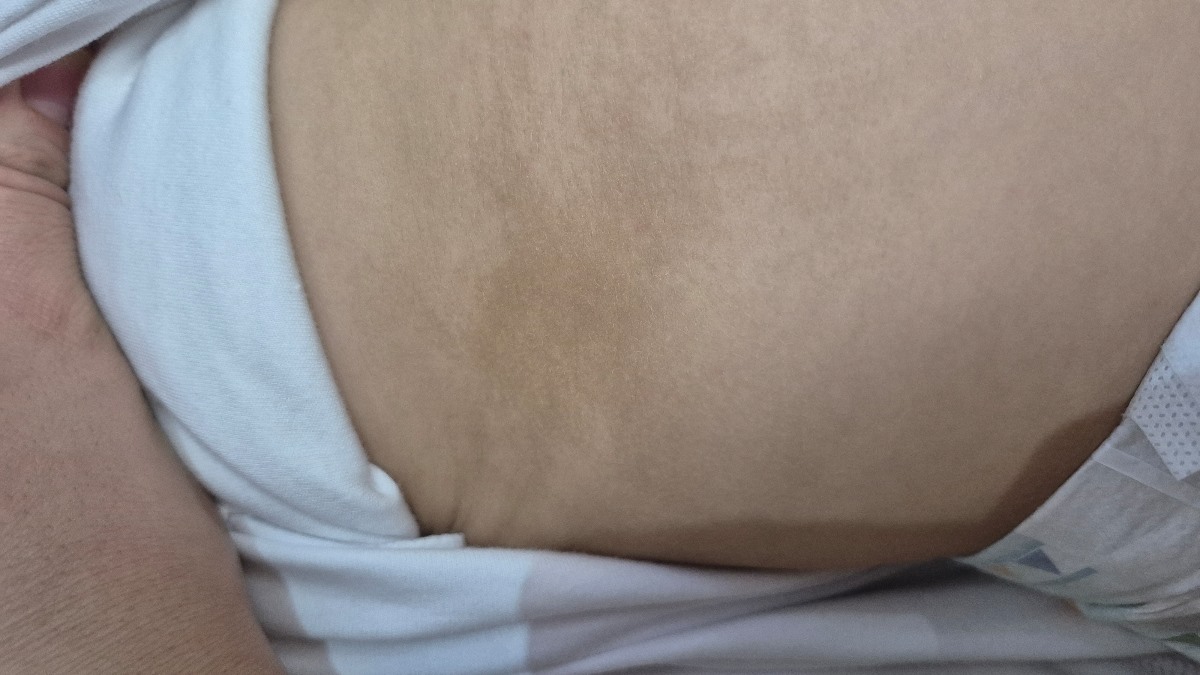 لک قهوه ای روی پوست شکم