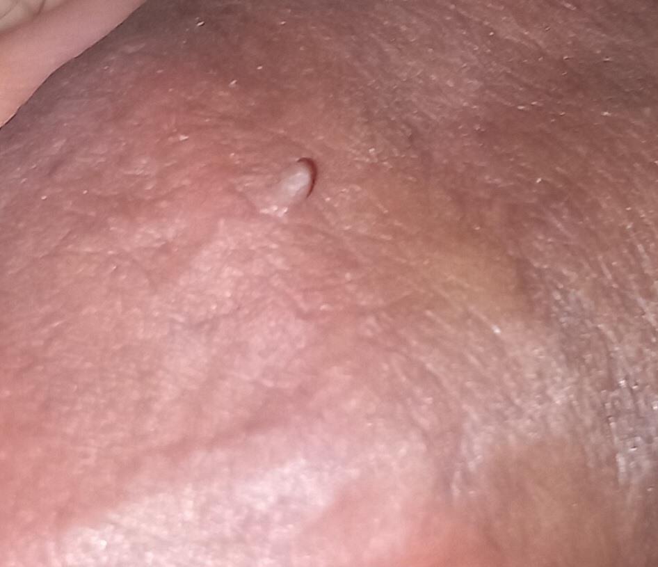 بررسی ضایعه روی آلت