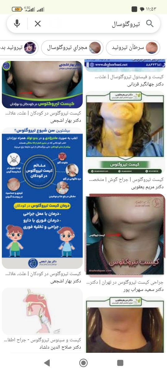 کیست مادرزادی تیروگلوسال در بچه 4 ساله