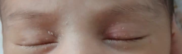 پوسته دادن روی پلک چشم نوزاد