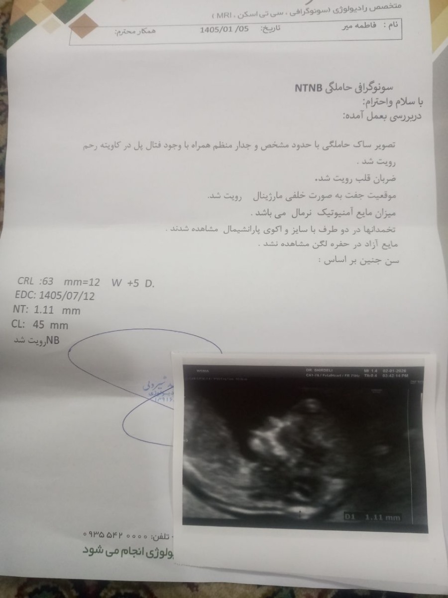 لطفا سنو آنومالی تفسیر کنید