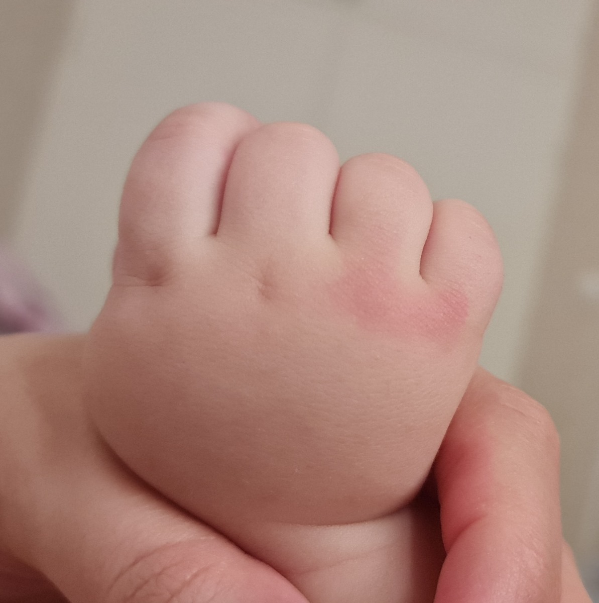 سوختگی دست نوزاد با جسم داغ سوختگی دست نوزاد با جسم داغ