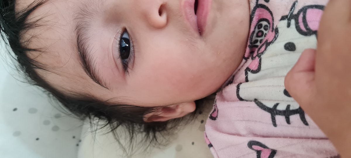 جوش صورت دخترم چکار کنم جوش صورت دخترم چکار کنم
