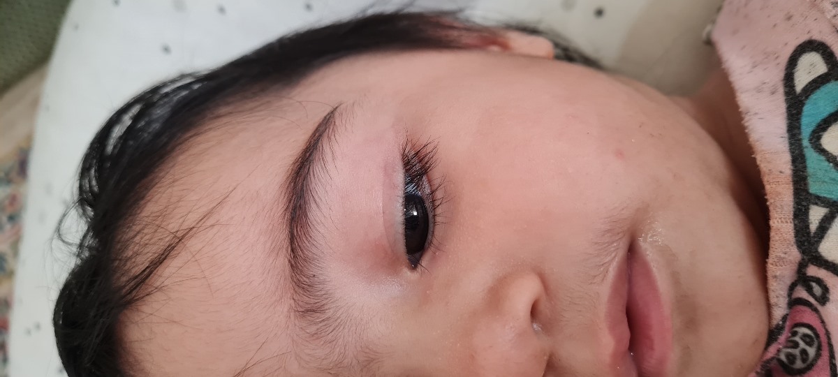 جوش صورت دخترم چکار کنم جوش صورت دخترم چکار کنم