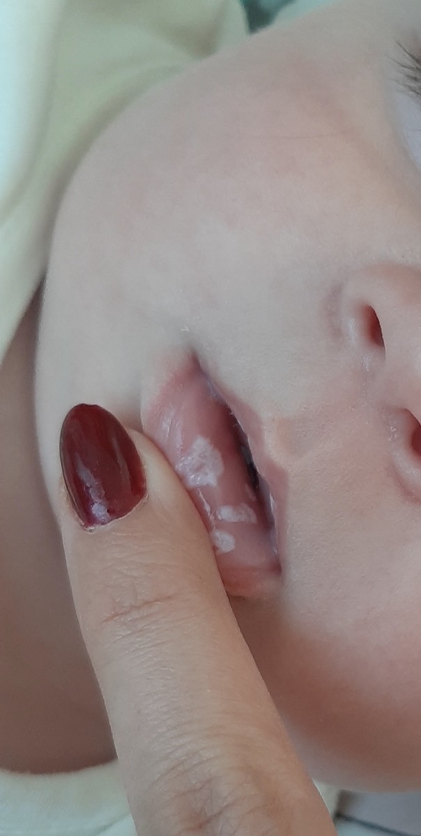 خانم دکتر دهن پسرم آفت و برفک زده چکار کنم خانم دکتر دهن پسرم آفت و برفک زده چکار کنم