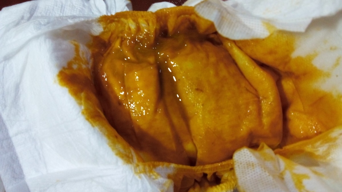 مدفوع نوزاد باید اینطوری شل باشه؟ مدفوع نوزاد باید اینطوری شل باشه؟