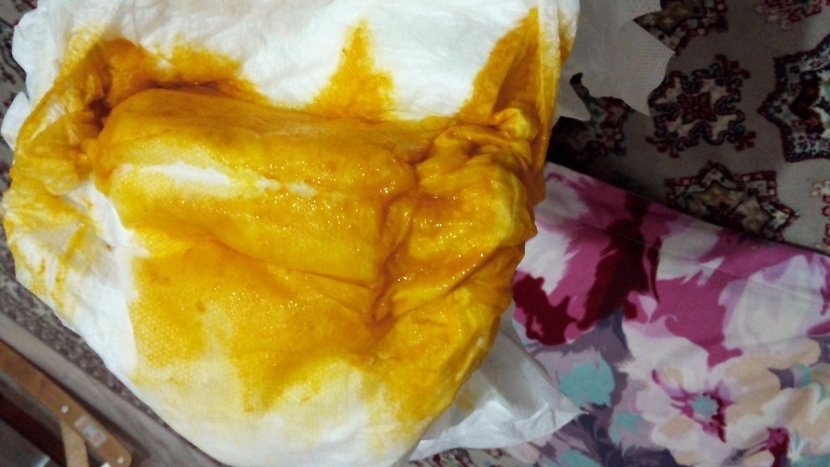 مدفوع نوزاد باید اینطوری شل باشه؟ مدفوع نوزاد باید اینطوری شل باشه؟