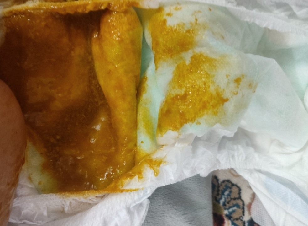 با عرض معذرت اینم عکس مدفوعش
با توجه به خلطی بودن مدفوعش تشخیص آلرژی به پروتئین گاوی دادید ، هر چقدر رعایت میکنم بازم خلطیه 😢
دکتر جان تا الان آزمایشی براش ندادم ، میشه بگید چه فاکتورایی براش ثبت بشه که کامل باشه ؟ اگه هم خودتون بتونید ثبت کنید که بهتر 