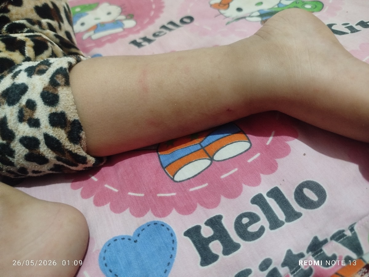 خارش پای کودک یکساله