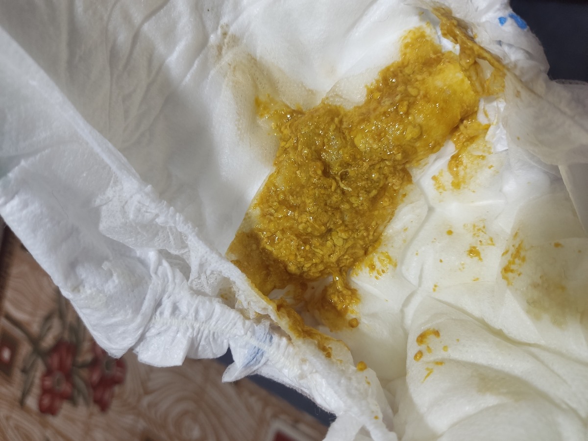 کف سر نوزاد پسر کف سر نوزاد پسر
