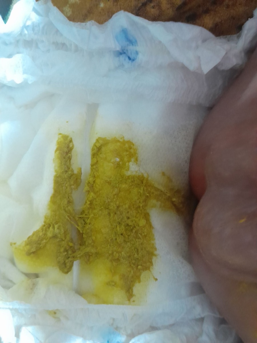 کف سر نوزاد یک ماهه
