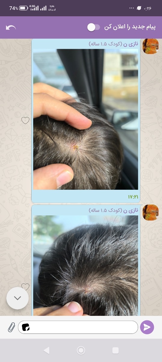 زخم روی سر پسرم