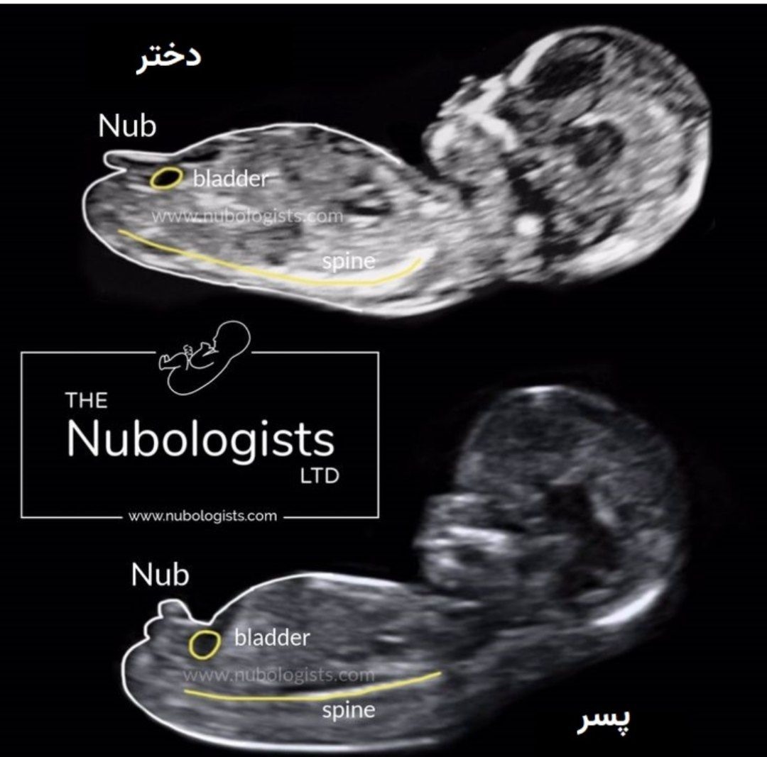 سونوان،تی سونوان،تی