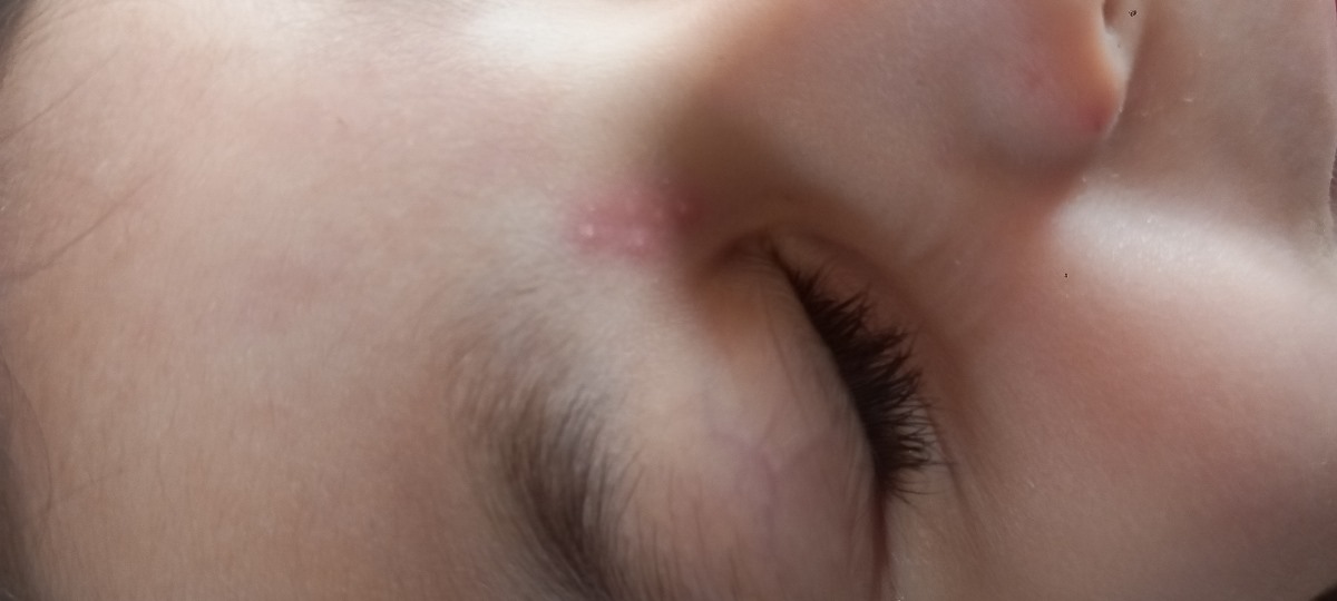 سلام خدمت خانوم‌دکتر عزیز دخترم صبح بیدار شده پای چشمش دونه زده