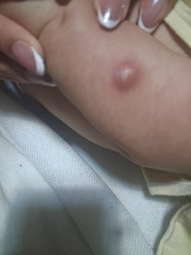 دست بچه دوماه چرا اینجوری شده؟