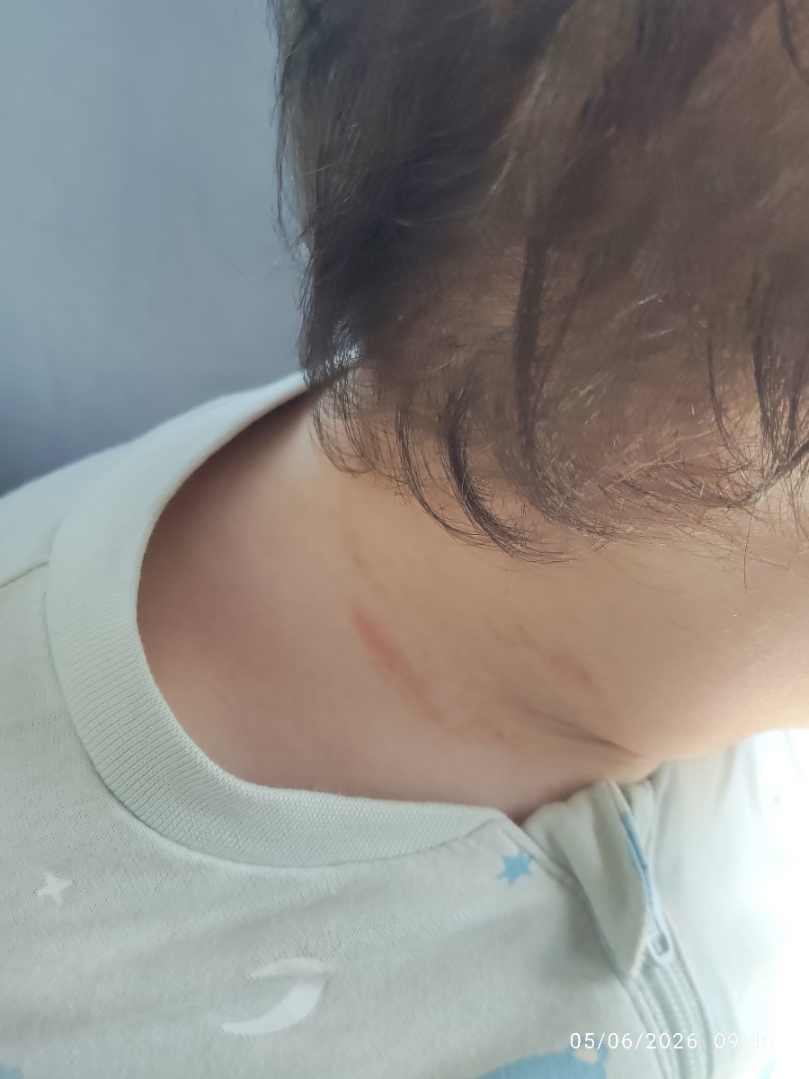 دونه های ماندگار گردن کودک دونه های ماندگار گردن کودک