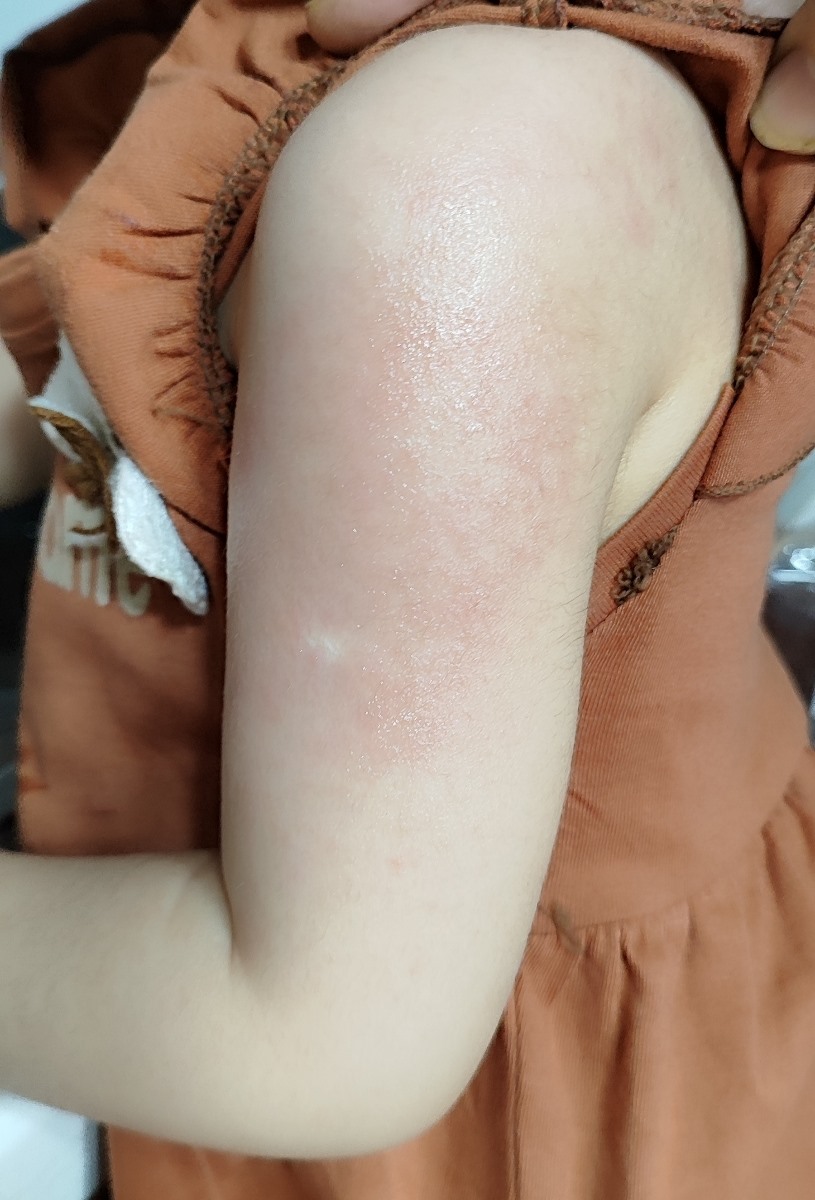 حساسیت بدن کودک ۲۰ ماهه