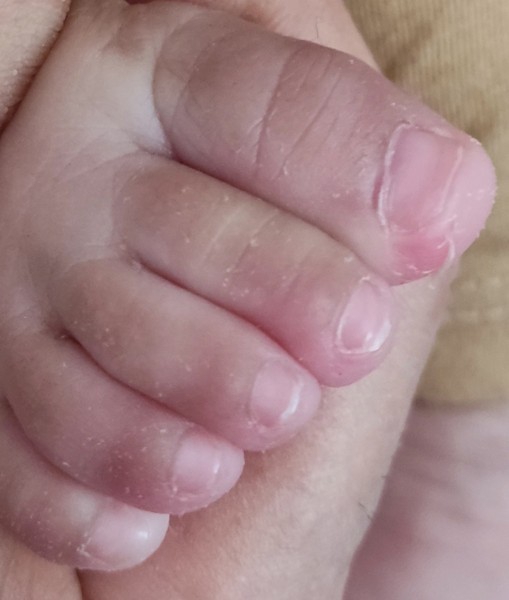 سلام خانم دکتر عزیز روی پا و انگشت پای دخترم چند روزه پوسته پوسته شده