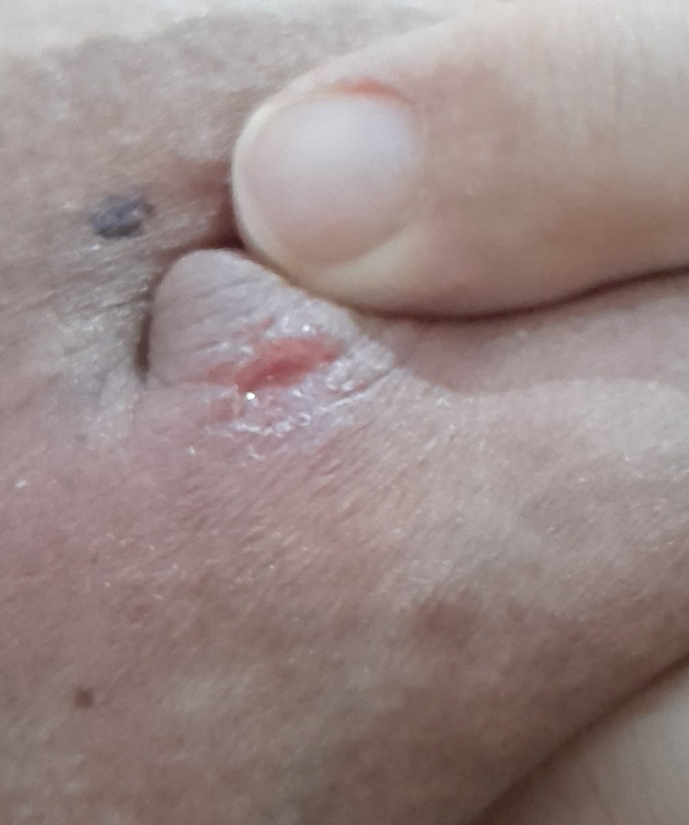 زخم شدن سینه در شیردهی