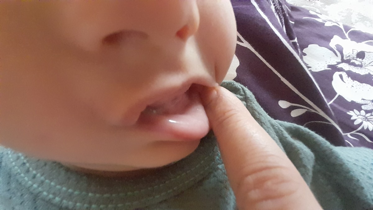 رفع برفک دهان نوزاد رفع برفک دهان نوزاد