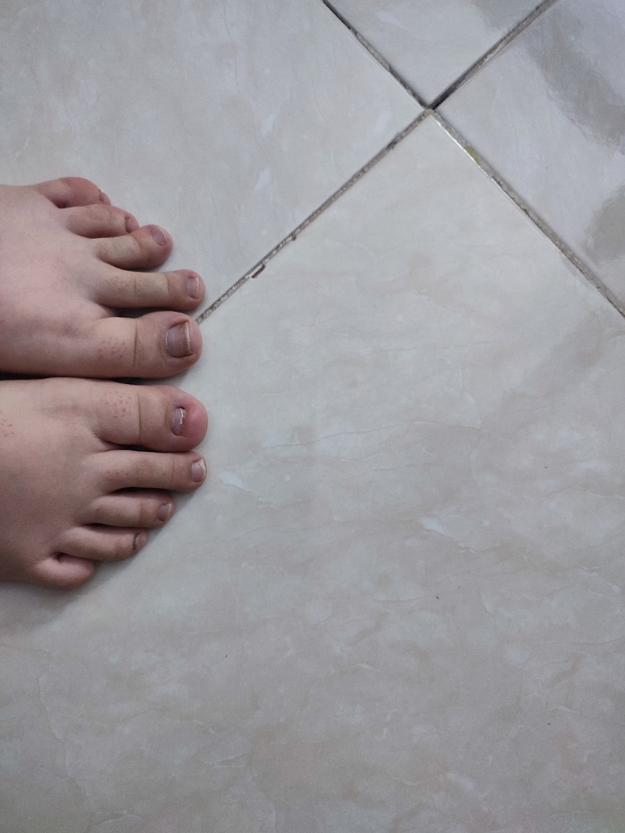 ناخن فرو رفته در گوشت پا ناخن فرو رفته در گوشت پا