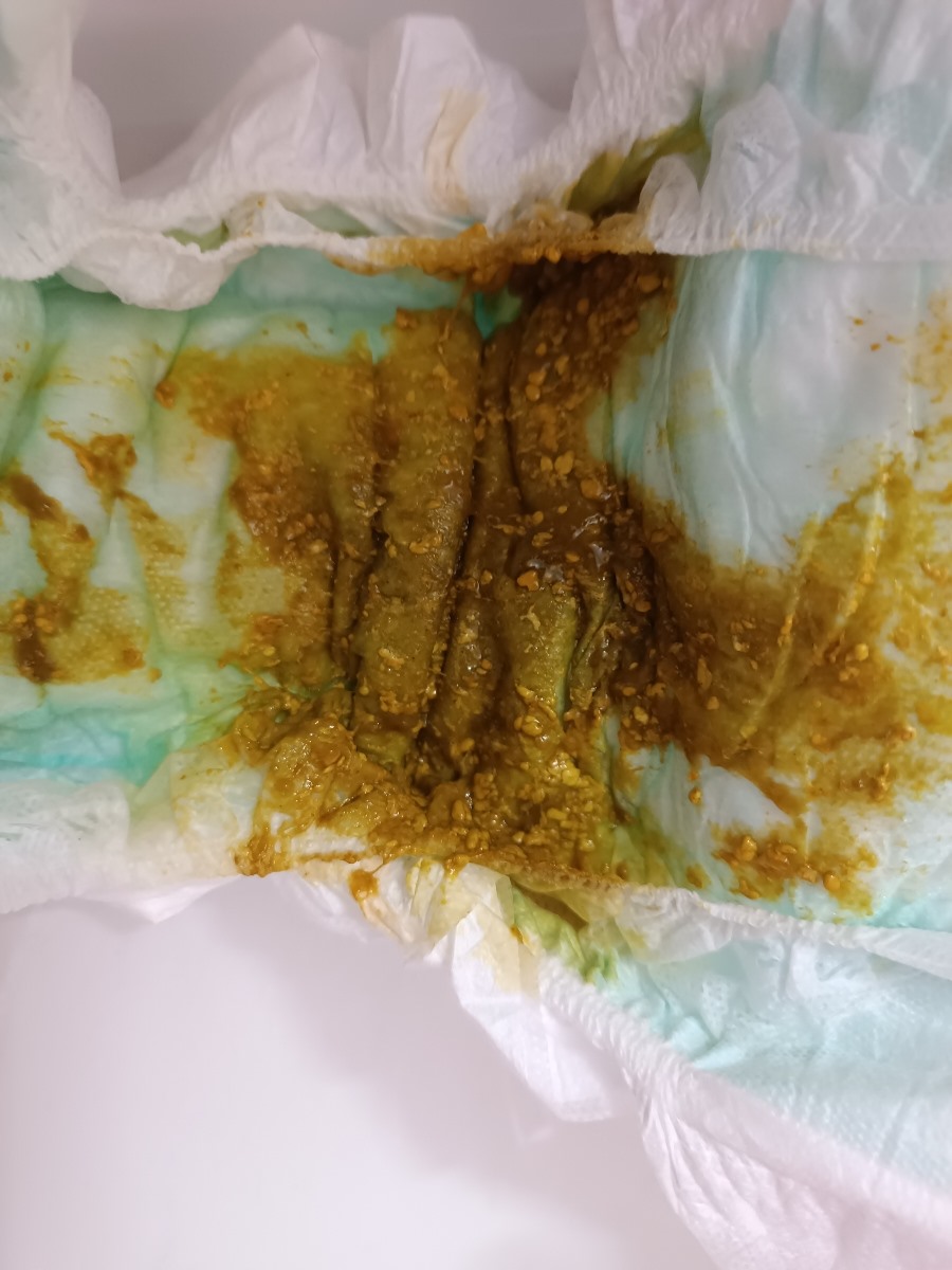 الان اینجوری شده داخلش مخاط (خلطی) داره الان اینجوری شده داخلش مخاط (خلطی) داره
