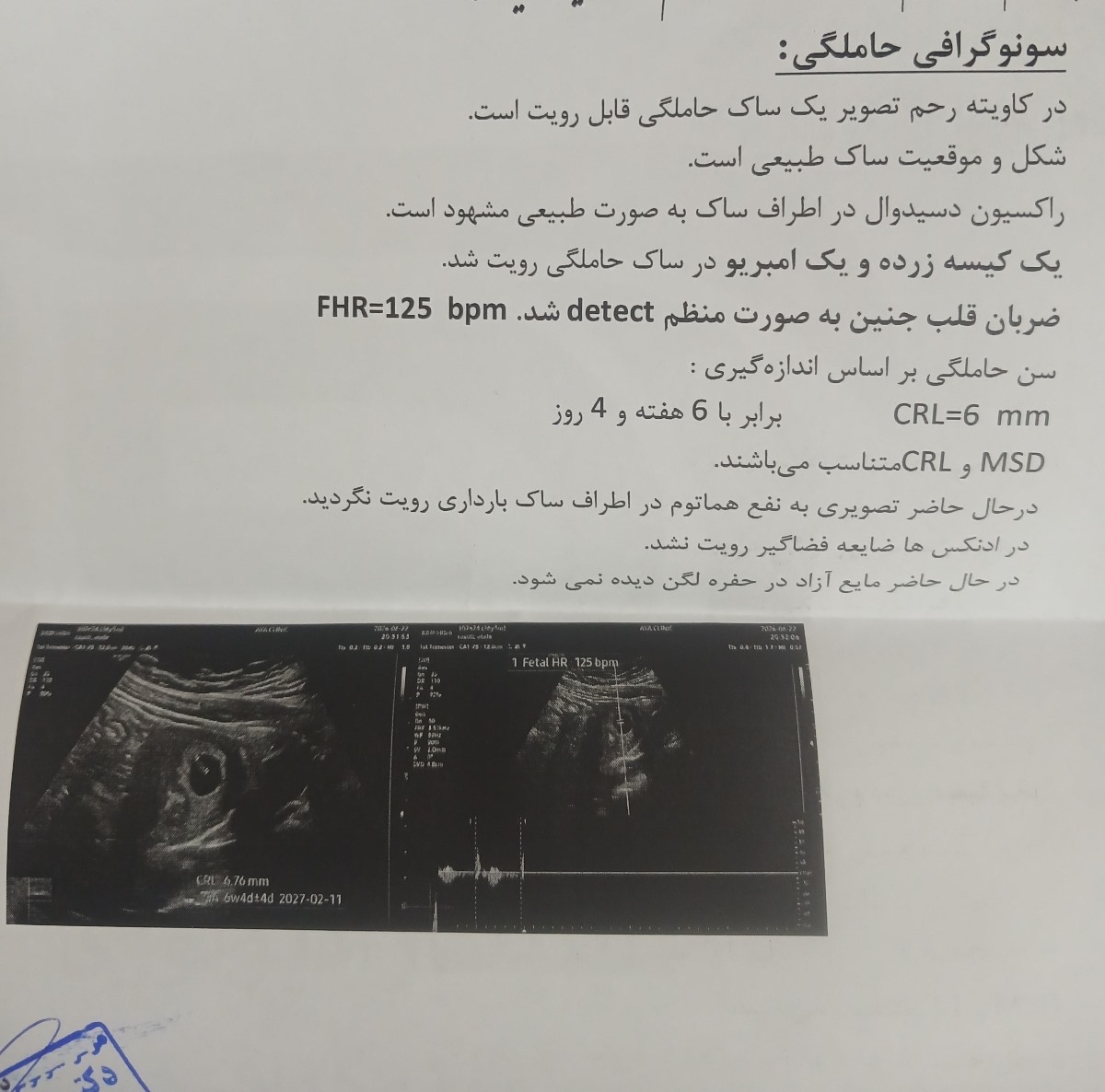 سونو ی شش هفته