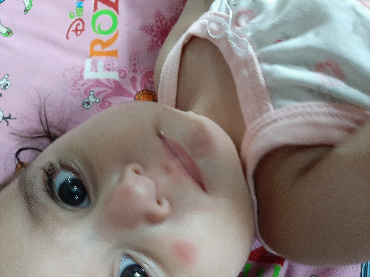 نیش پشه و جوش