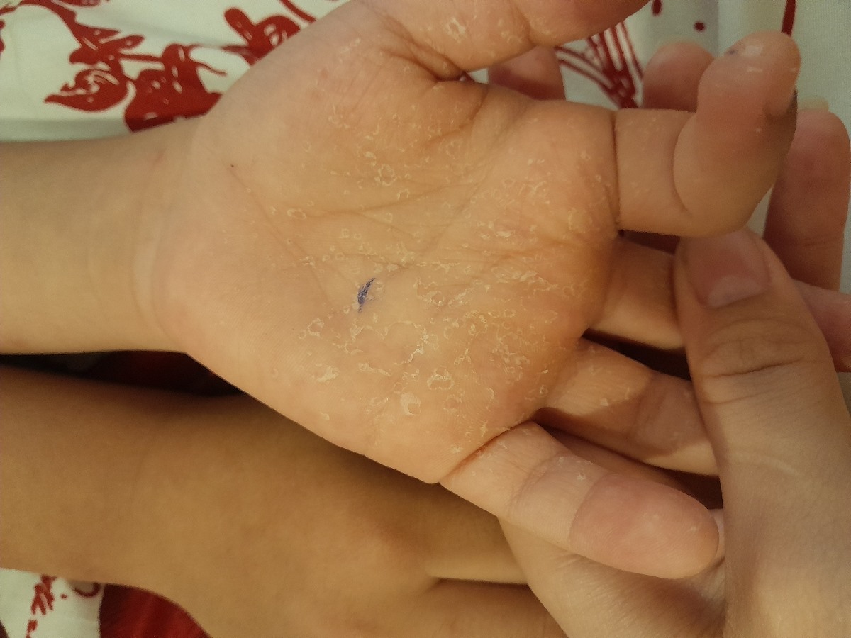 پوسته پوسته شدن کف پا و دست 🙌🏻🦶🏻👣 پوسته پوسته شدن کف پا و دست 🙌🏻🦶🏻👣