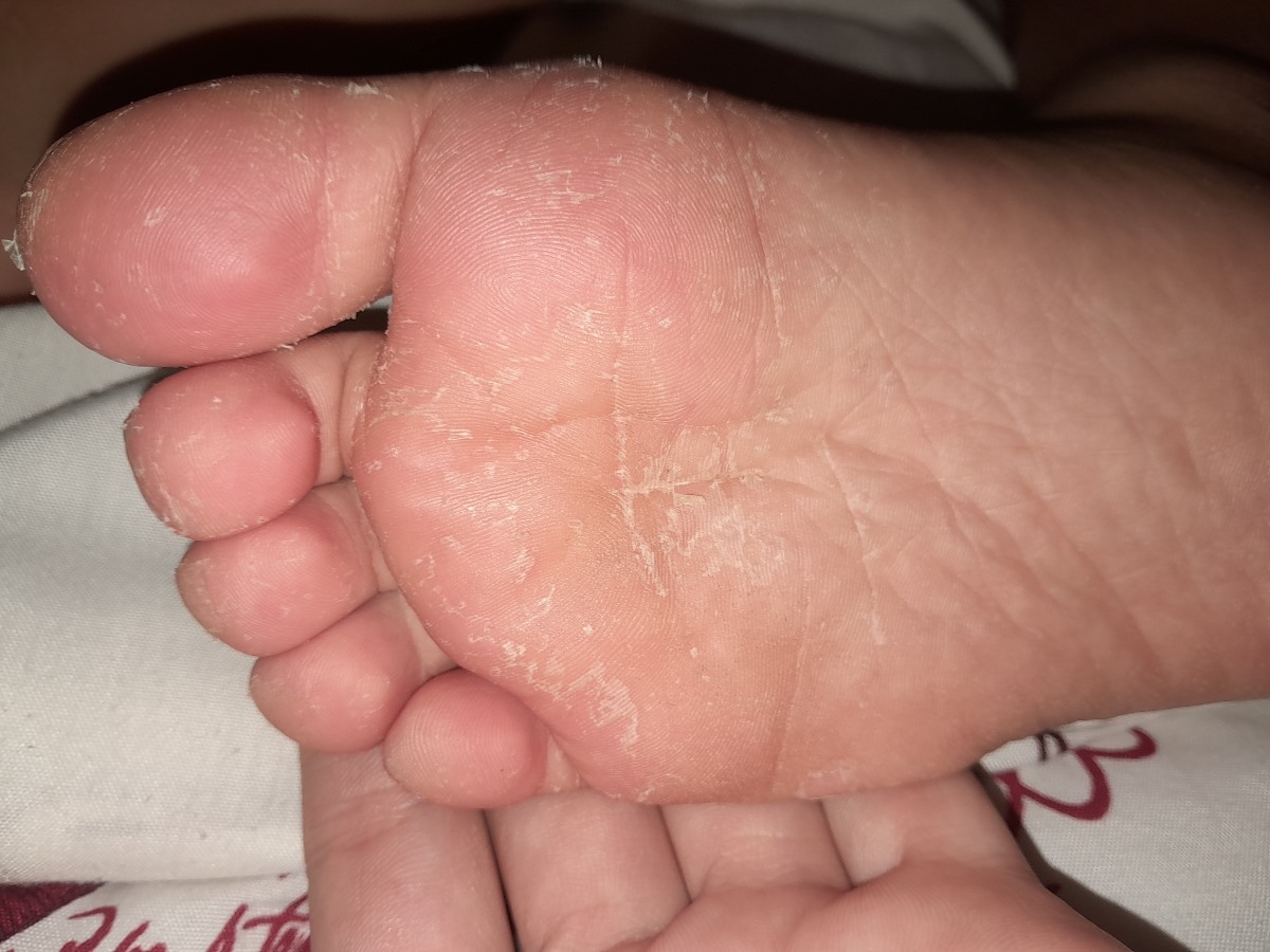 پوسته پوسته شدن کف پا و دست 🙌🏻🦶🏻👣 پوسته پوسته شدن کف پا و دست 🙌🏻🦶🏻👣