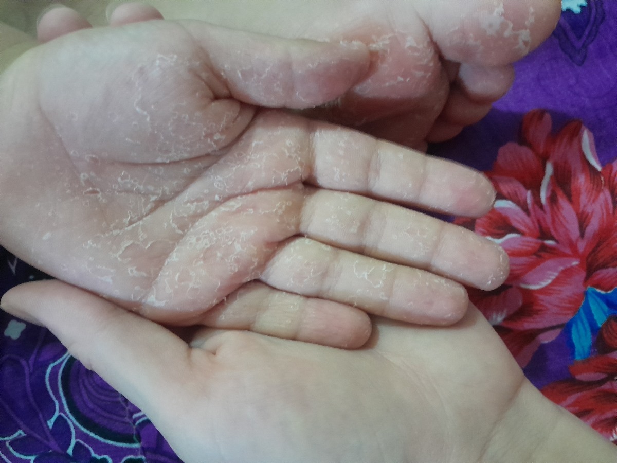 پوسته پوسته شدن کف پا و دست 🙌🏻🦶🏻👣 پوسته پوسته شدن کف پا و دست 🙌🏻🦶🏻👣