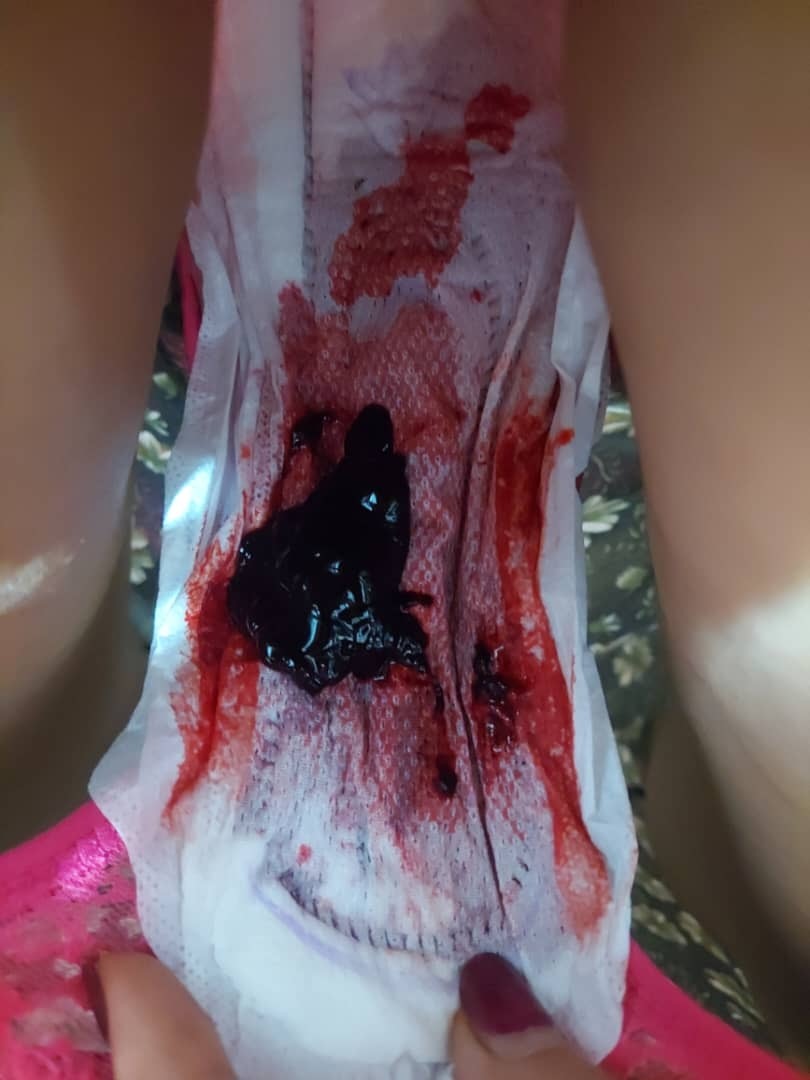 اورژانسی خونریزی شدید چند روز بعد از پریودی اورژانسی خونریزی شدید چند روز بعد از پریودی
