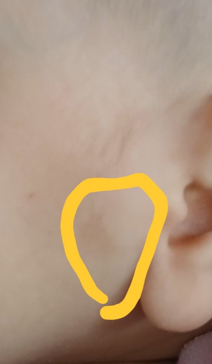 لک قهوه ای روی‌ پوست نوزاد