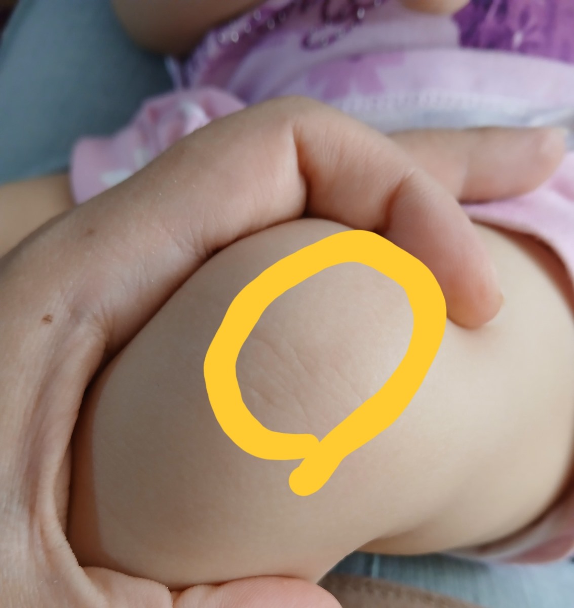 لک قهوه ای روی‌ پوست نوزاد