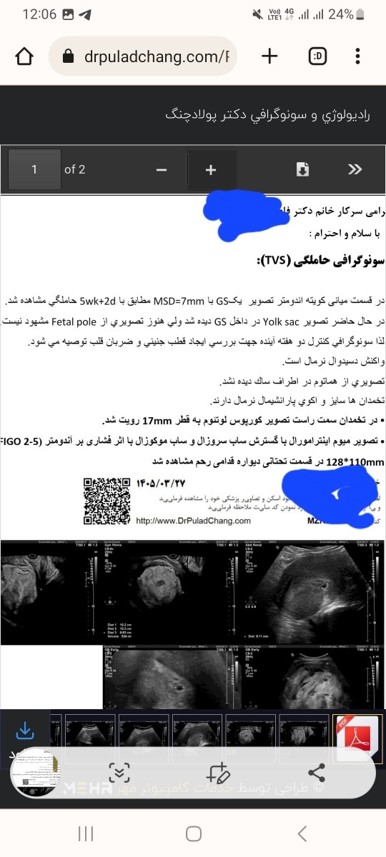 ترشح قهوه ای در ۷ هفته بارداری ترشح قهوه ای در ۷ هفته بارداری