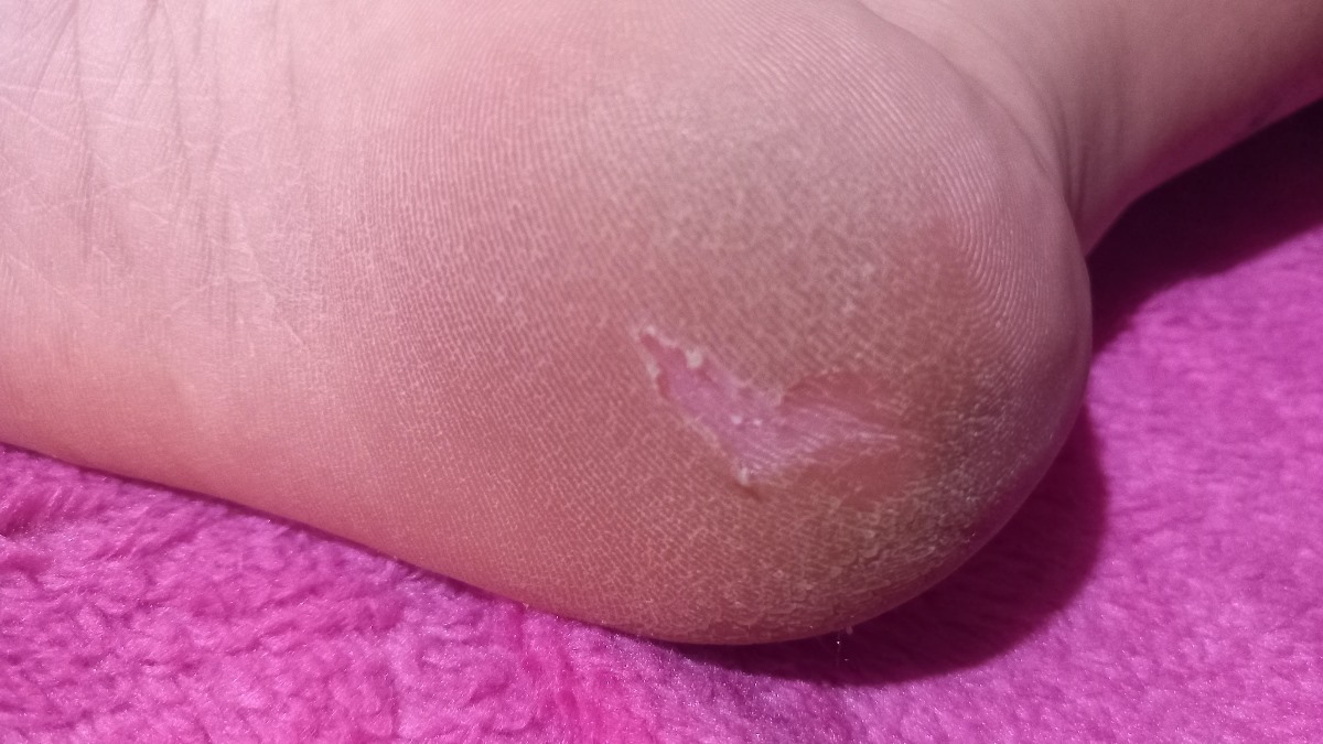 کف پام پوست میده 🤕