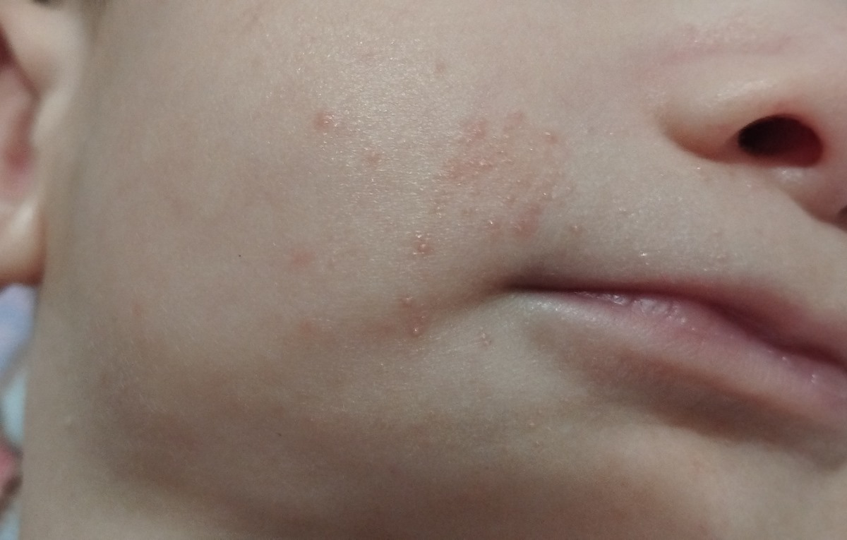 جوش روی صورت کنار لب
