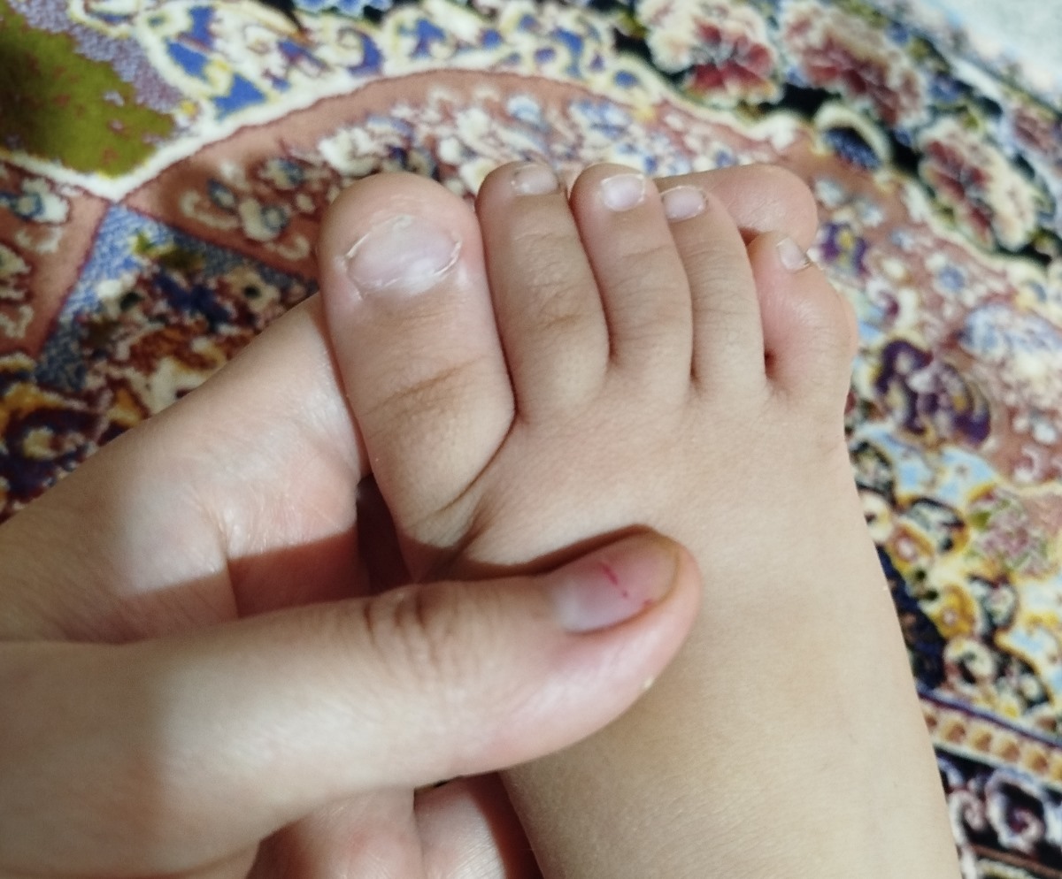 کم خونی شکل ناخن ها