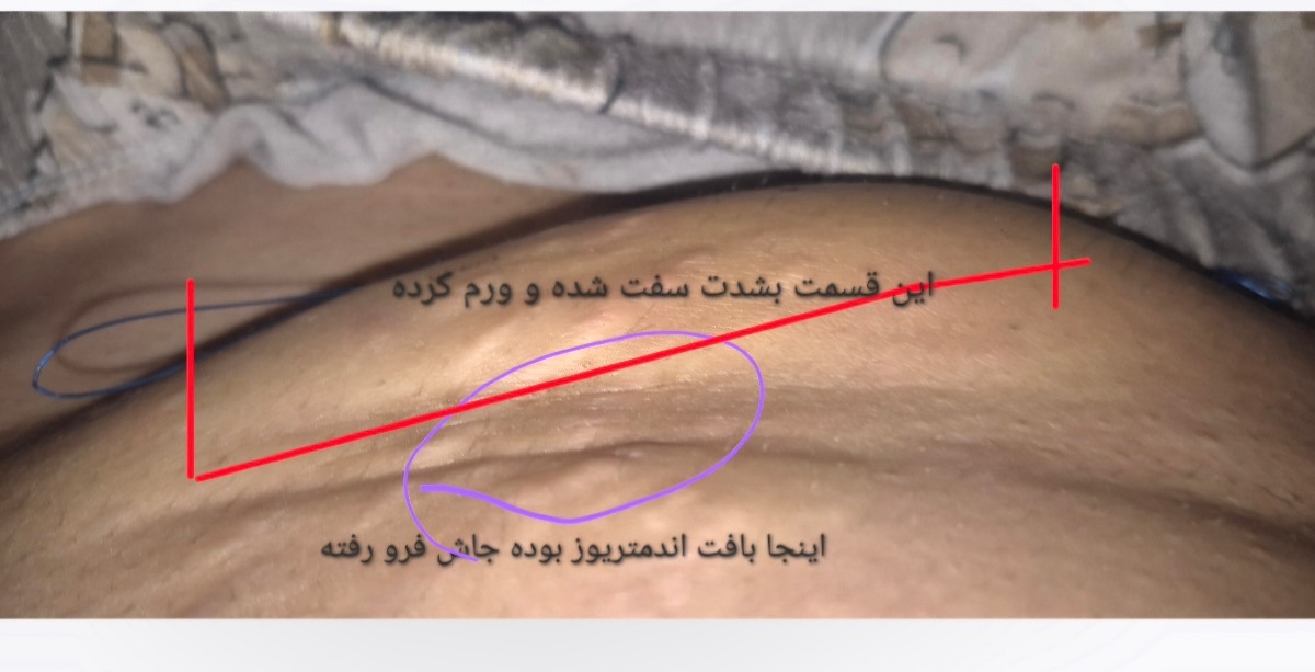 سفت شدن جای عمل