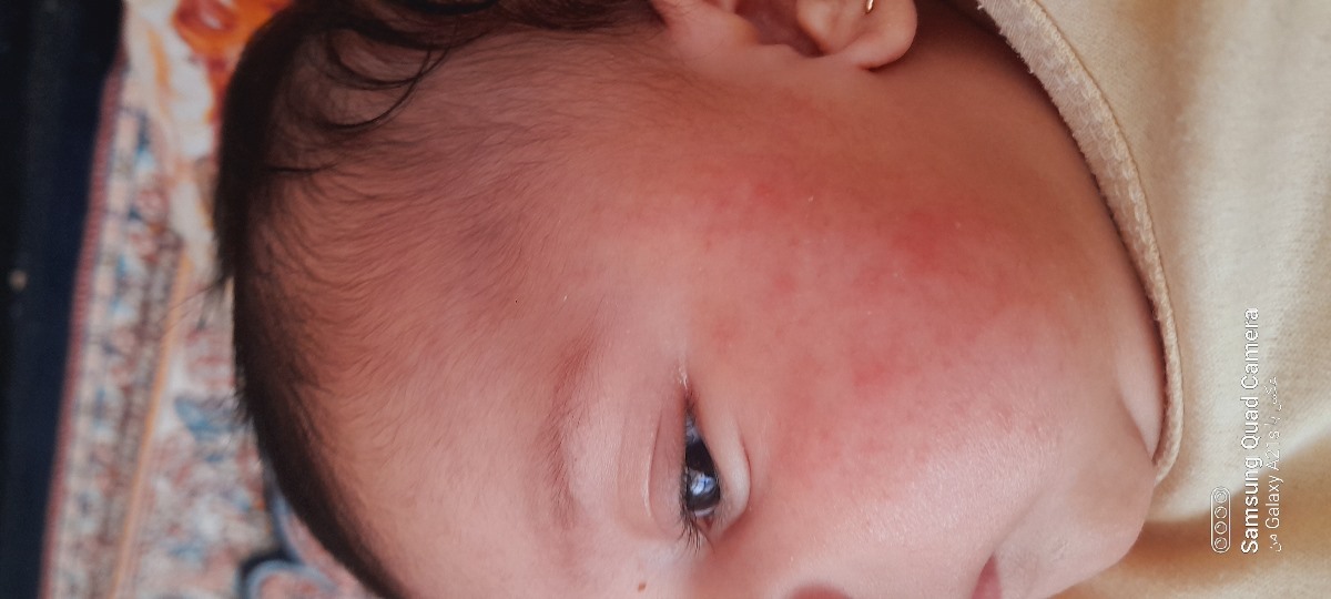 دکترجان صورت نوزادم چرااینجوری شده؟