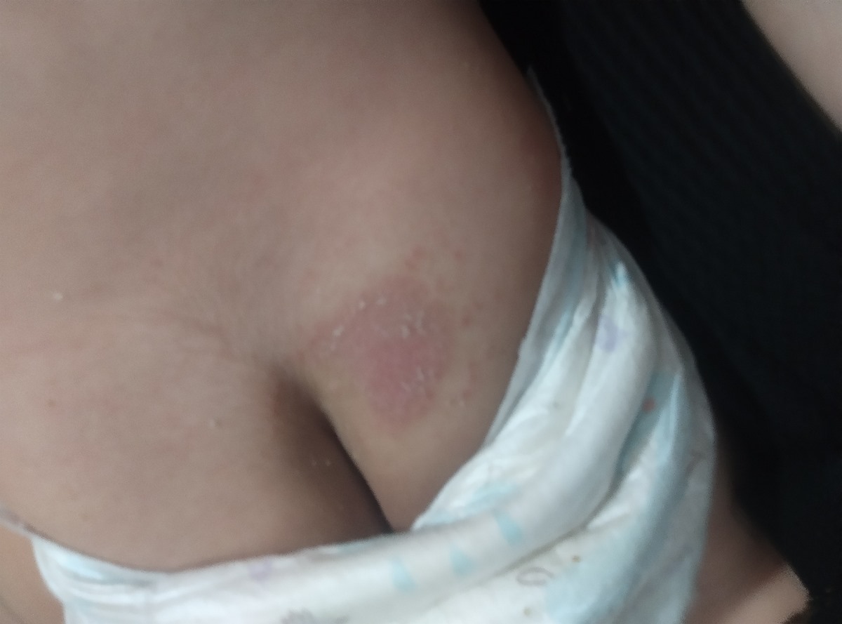 دخترم چند روزه پشت باسن لک پوستی داره دخترم چند روزه پشت باسن لک پوستی داره