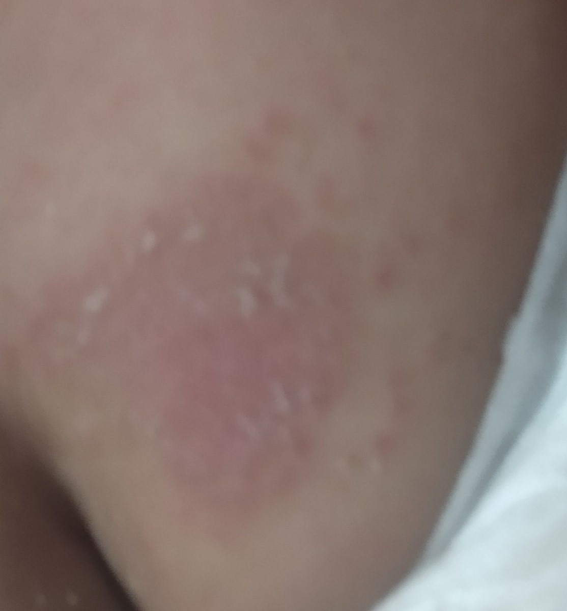 دخترم چند روزه پشت باسن لک پوستی داره دخترم چند روزه پشت باسن لک پوستی داره